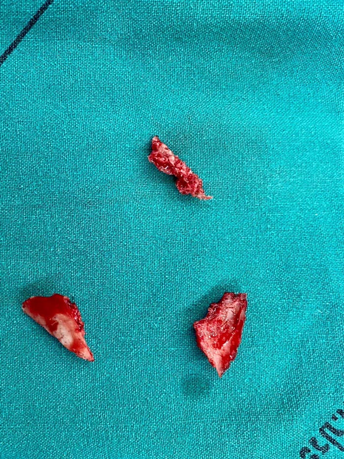 กะโหลกศีรษะแตก ฝังในสมอง กะโหลกศีรษะแตก ฝังในสมอง