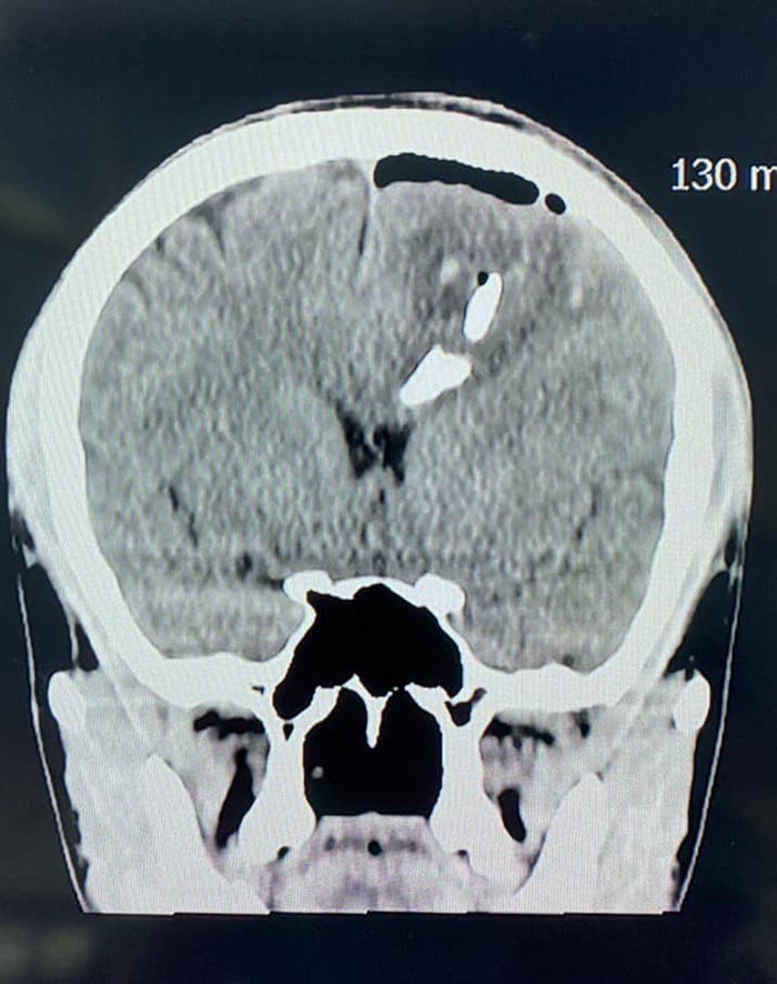 กะโหลกศีรษะแตก ฝังในสมอง กะโหลกศีรษะแตก ฝังในสมอง