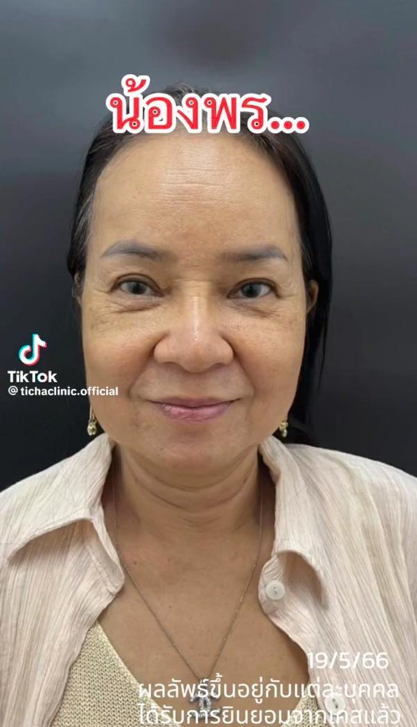พี่พร คู่รักต่างวัย ศัลยกรรมดึงหน้า พี่พร คู่รักต่างวัย ศัลยกรรมดึงหน้า