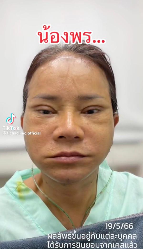 พี่พร คู่รักต่างวัย ศัลยกรรมดึงหน้า พี่พร คู่รักต่างวัย ศัลยกรรมดึงหน้า