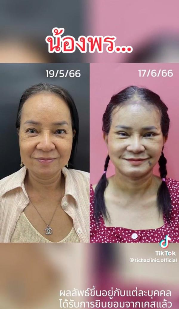 พี่พร คู่รักต่างวัย ศัลยกรรมดึงหน้า พี่พร คู่รักต่างวัย ศัลยกรรมดึงหน้า
