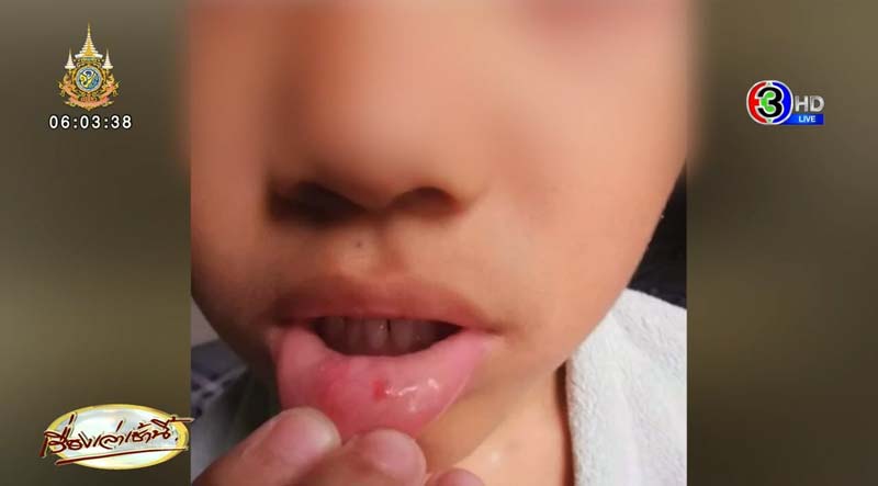 ครูใช้เข็มทิ่มปากนักเรียน ครูใช้เข็มทิ่มปากนักเรียน