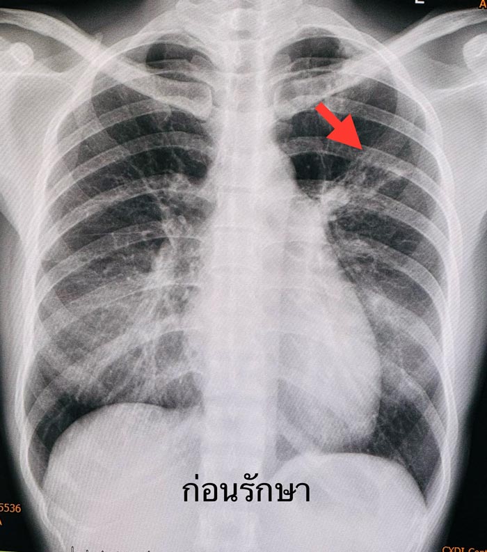 ไอเป็นเลือด ไอเป็นเลือด