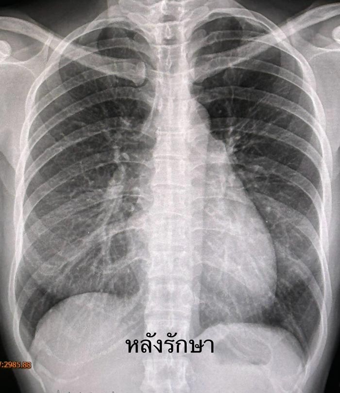 วัณโรค วัณโรค