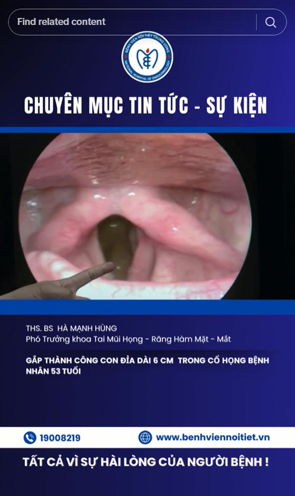 ปลิงในคอ ปลิงในคอ
