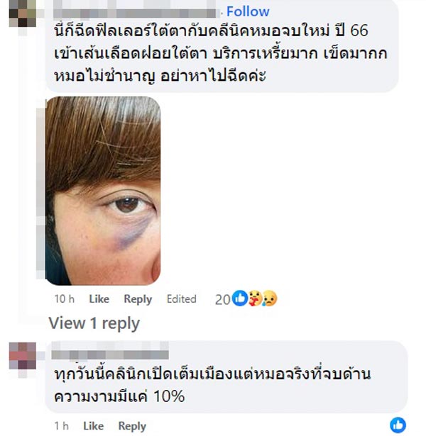 ฉีดฟิลเลอร์ ฉีดฟิลเลอร์