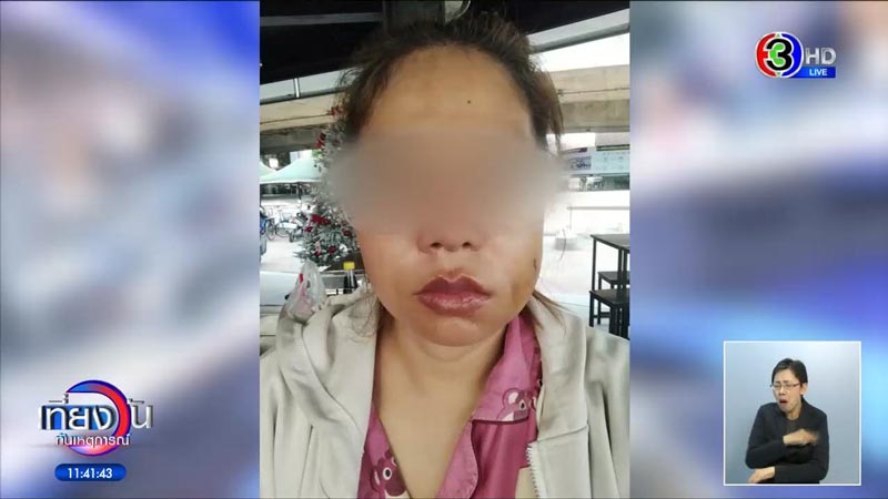 ผ่าตัดลักยิ้ม ผ่าตัดลักยิ้ม