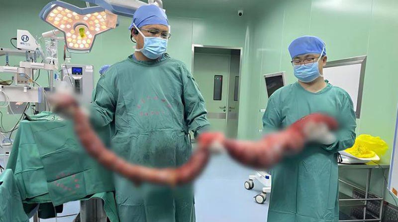 โรคลำไส้โป่งพอง โรคลำไส้โป่งพอง