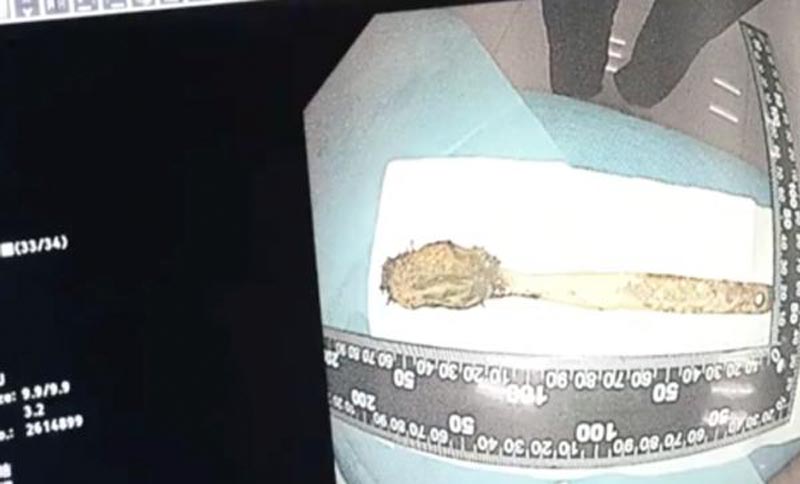 แปรงสีฟันติดอยู่ในลำไส้เล็ก แปรงสีฟันติดอยู่ในลำไส้เล็ก