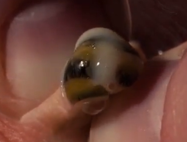 หอยทาก ในแผล หอยทาก ในแผล