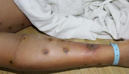 ฝูงแตนอาละวาด ต่อยชาวบ้านในประเทศจีน ฝูงแตนอาละวาด ต่อยชาวบ้านในประเทศจีน