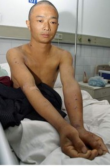 ฝูงแตนอาละวาด ต่อยชาวบ้านในประเทศจีน ฝูงแตนอาละวาด ต่อยชาวบ้านในประเทศจีน