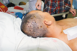 ฝูงแตนอาละวาด ต่อยชาวบ้านในประเทศจีน ฝูงแตนอาละวาด ต่อยชาวบ้านในประเทศจีน