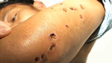 ฝูงแตนอาละวาด ต่อยชาวบ้านในประเทศจีน ฝูงแตนอาละวาด ต่อยชาวบ้านในประเทศจีน