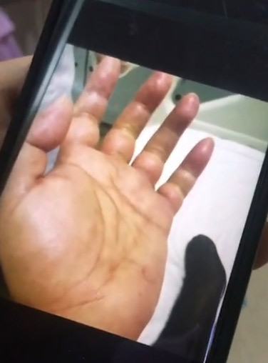 ก้างปลาทิ่มจนมือเน่าต้องตัดทิ้ง ก้างปลาทิ่มจนมือเน่าต้องตัดทิ้ง