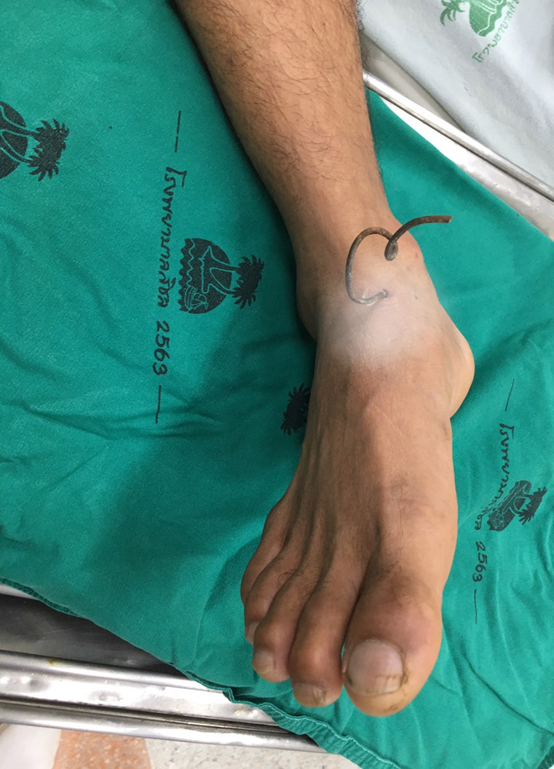 เหล็กเสียบขาคนตัดหญ้า เหล็กเสียบขาคนตัดหญ้า