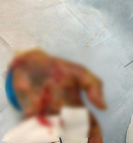 ก้างปลาทิ่มจนมือเน่าต้องตัดทิ้ง ก้างปลาทิ่มจนมือเน่าต้องตัดทิ้ง