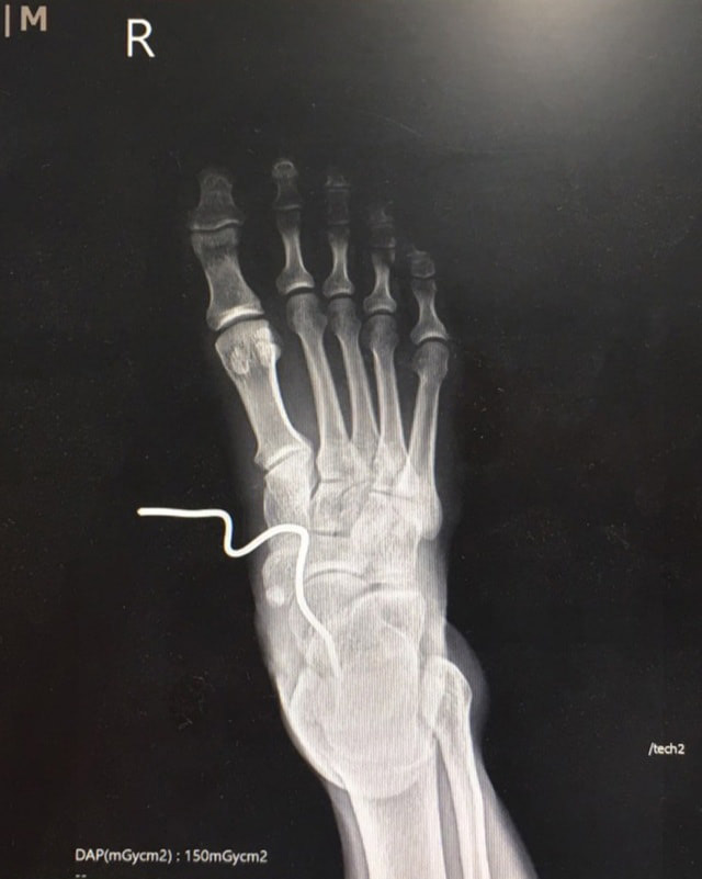 เหล็กเสียบขาคนตัดหญ้า เหล็กเสียบขาคนตัดหญ้า