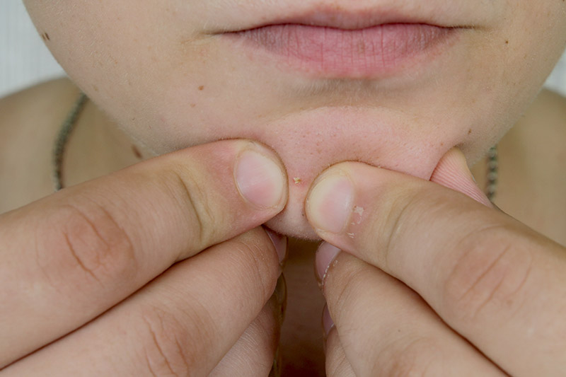 บีบสิว ป่วยหนักปางตาย บีบสิว ป่วยหนักปางตาย