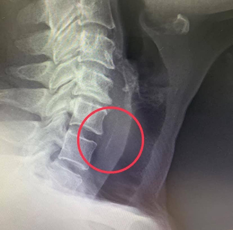 เปลือกกุ้งแทงหลอดอาหาร เปลือกกุ้งแทงหลอดอาหาร