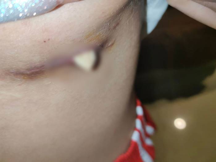 สาวเสริมหน้าอก หมอลืมเอาผ้าก๊อซออก สาวเสริมหน้าอก หมอลืมเอาผ้าก๊อซออก