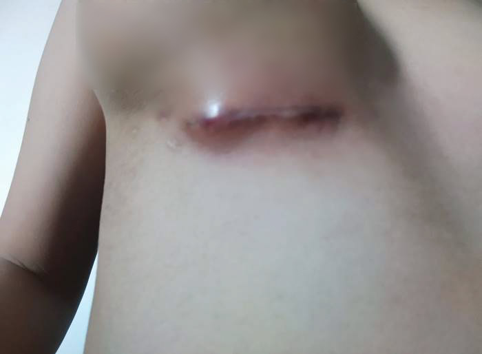 สาวเสริมหน้าอก หมอลืมเอาผ้าก๊อซออก สาวเสริมหน้าอก หมอลืมเอาผ้าก๊อซออก