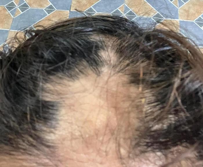 ยืดผม 5 ชั่วโมง ผมร่วงเกือบหมดหัว ยืดผม 5 ชั่วโมง ผมร่วงเกือบหมดหัว