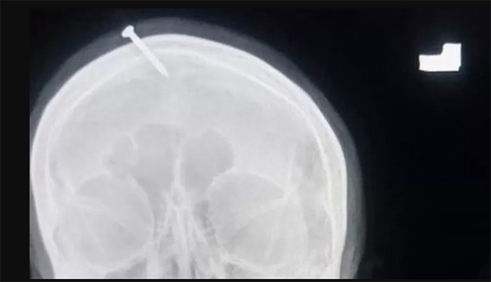 หมอผีตอกตะปูใส่กะโหลกหญิงท้อง หมอผีตอกตะปูใส่กะโหลกหญิงท้อง