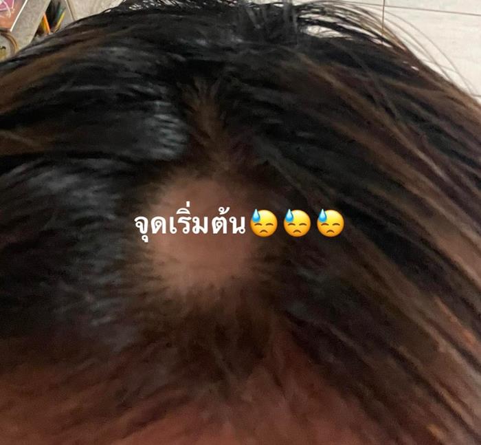 ยืดผม 5 ชั่วโมง ผมร่วงเกือบหมดหัว ยืดผม 5 ชั่วโมง ผมร่วงเกือบหมดหัว