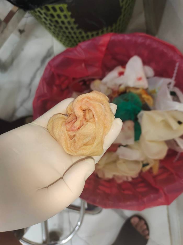 สาวเสริมหน้าอก หมอลืมเอาผ้าก๊อซออก สาวเสริมหน้าอก หมอลืมเอาผ้าก๊อซออก