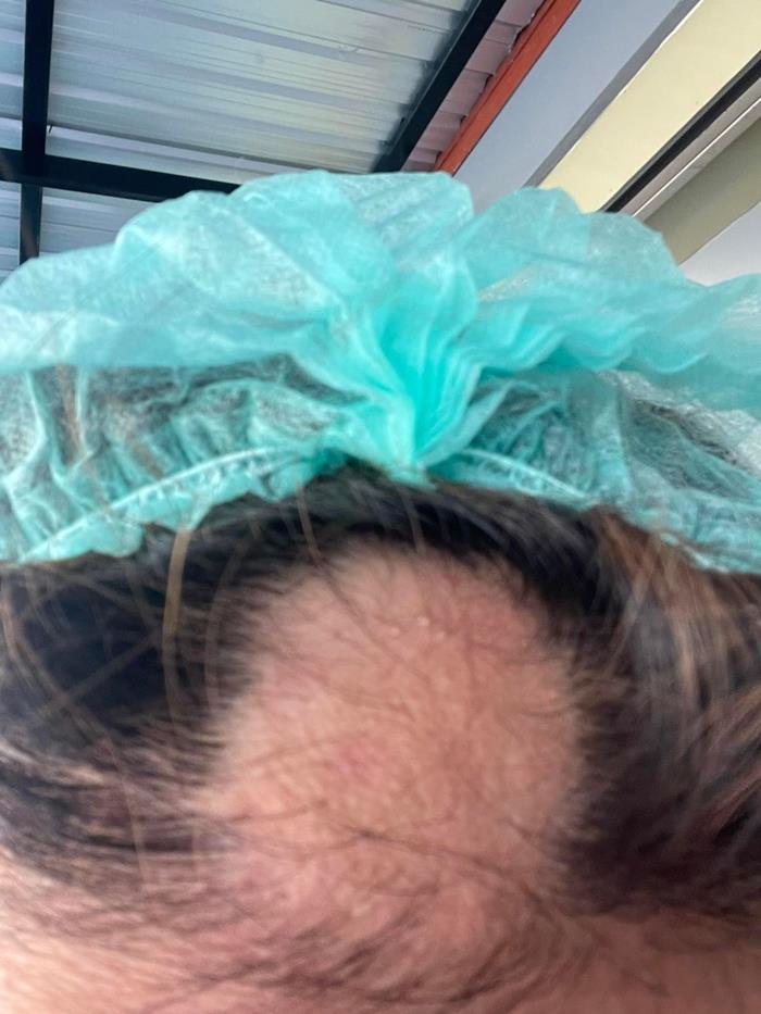 ยืดผม 5 ชั่วโมง ผมร่วงเกือบหมดหัว ยืดผม 5 ชั่วโมง ผมร่วงเกือบหมดหัว