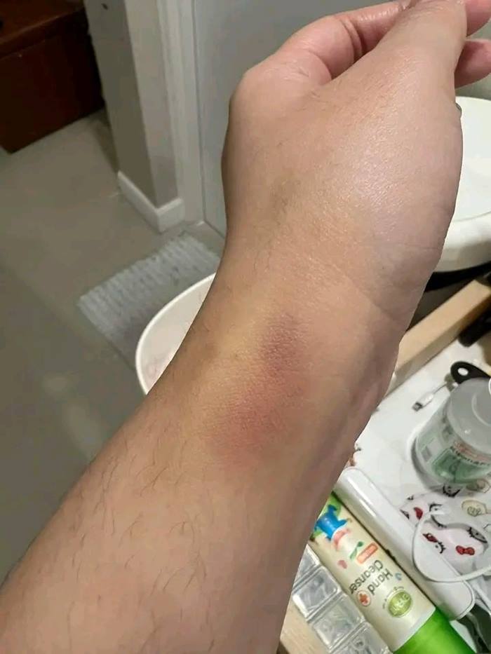 ลูกค้าแพ้กุ้งเกือบตาย โรงแรมให้วอยเชอร์กลับมากินอีก ลูกค้าแพ้กุ้งเกือบตาย โรงแรมให้วอยเชอร์กลับมากินอีก