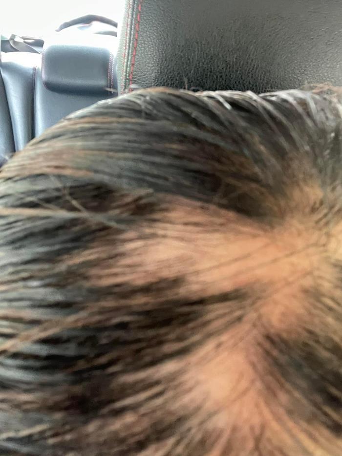 ยืดผม 5 ชั่วโมง ผมร่วงเกือบหมดหัว ยืดผม 5 ชั่วโมง ผมร่วงเกือบหมดหัว