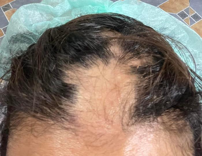 ยืดผม 5 ชั่วโมง ผมร่วงเกือบหมดหัว ยืดผม 5 ชั่วโมง ผมร่วงเกือบหมดหัว