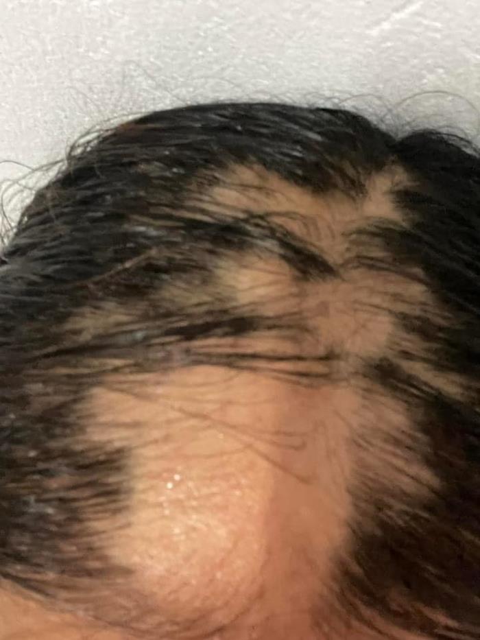 ยืดผม 5 ชั่วโมง ผมร่วงเกือบหมดหัว ยืดผม 5 ชั่วโมง ผมร่วงเกือบหมดหัว