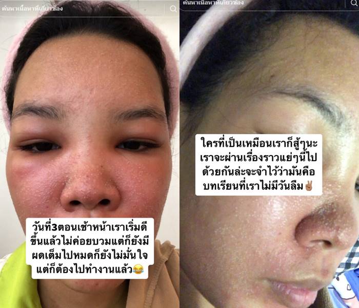 สาวรีวิว ครีมหน้าขาว หน้าอักเสบ ผื่น บวม แดง สาวรีวิว ครีมหน้าขาว หน้าอักเสบ ผื่น บวม แดง