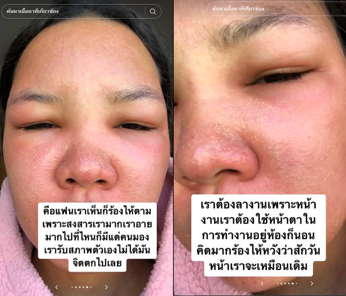 สาวรีวิว ครีมหน้าขาว หน้าอักเสบ ผื่น บวม แดง สาวรีวิว ครีมหน้าขาว หน้าอักเสบ ผื่น บวม แดง