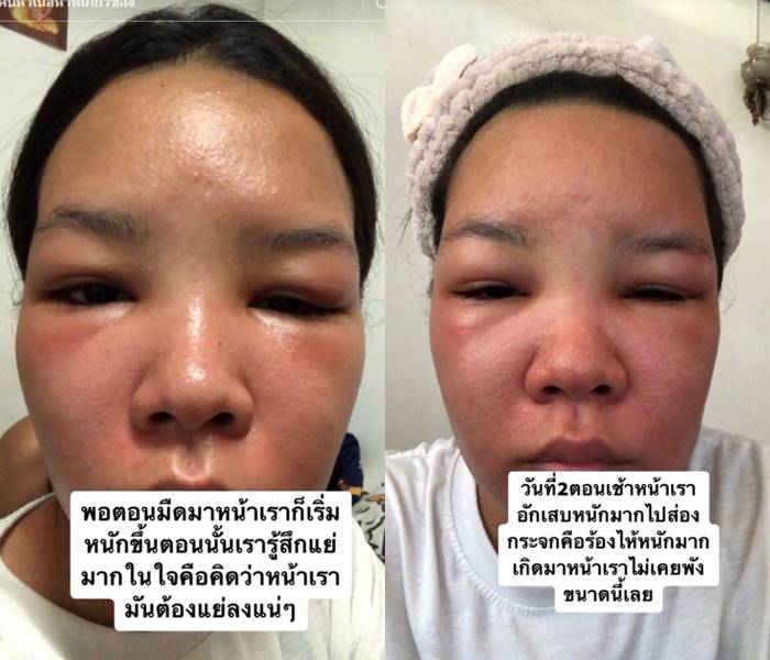 สาวรีวิว ครีมหน้าขาว หน้าอักเสบ ผื่น บวม แดง สาวรีวิว ครีมหน้าขาว หน้าอักเสบ ผื่น บวม แดง