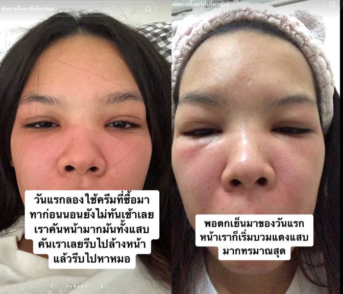 สาวรีวิว ครีมหน้าขาว หน้าอักเสบ ผื่น บวม แดง สาวรีวิว ครีมหน้าขาว หน้าอักเสบ ผื่น บวม แดง