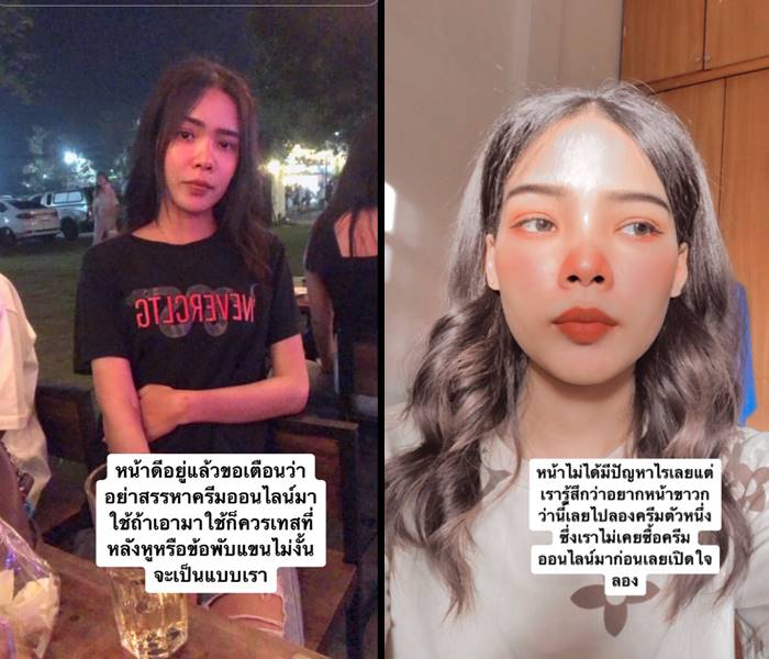 สาวรีวิว ครีมหน้าขาว หน้าอักเสบ ผื่น บวม แดง สาวรีวิว ครีมหน้าขาว หน้าอักเสบ ผื่น บวม แดง