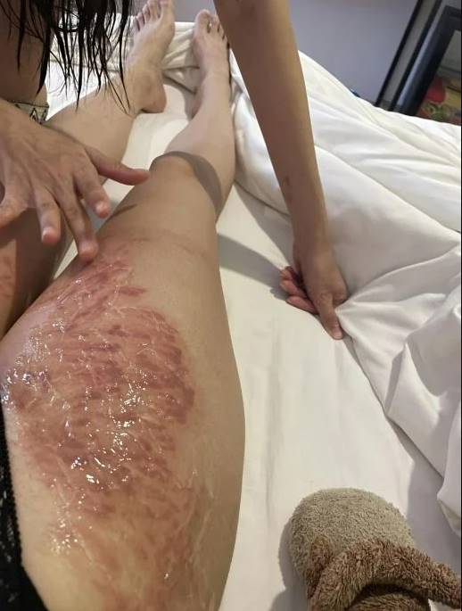 พิษดอกไม้ทะเล พิษดอกไม้ทะเล