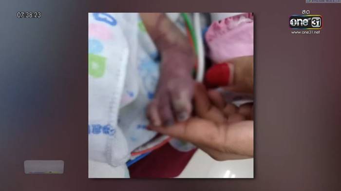 เด็ก1เดือน ท้องเสียถูกตัดเท้า เด็ก1เดือน ท้องเสียถูกตัดเท้า