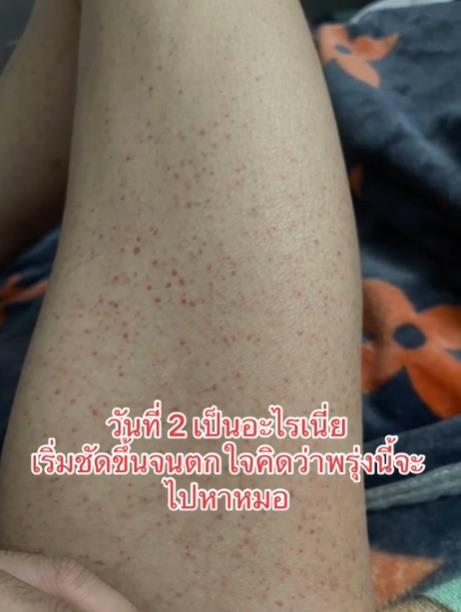 โรคภูมิคุ้มกันเป็นพิษ โรคภูมิคุ้มกันเป็นพิษ