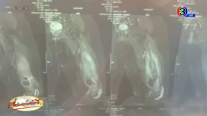 เด็ก ป.6 ถูกครูสั่งลุกนั่ง 150 ครั้ง กระดูกร้าว อดเข้า ม.1 เด็ก ป.6 ถูกครูสั่งลุกนั่ง 150 ครั้ง กระดูกร้าว อดเข้า ม.1