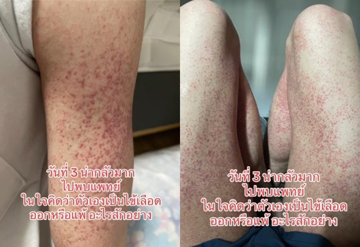 โรคภูมิคุ้มกันเป็นพิษ โรคภูมิคุ้มกันเป็นพิษ