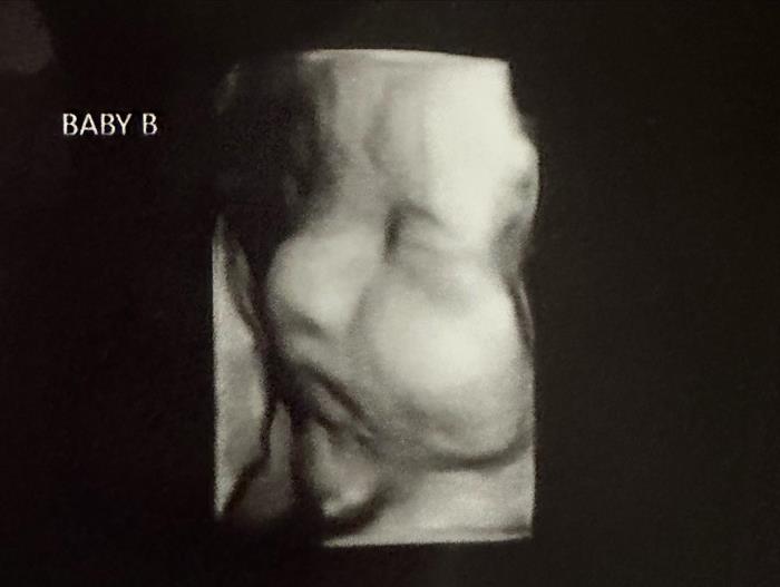 ท้องลูกแฝด ในมดลูกแฝด ท้องลูกแฝด ในมดลูกแฝด