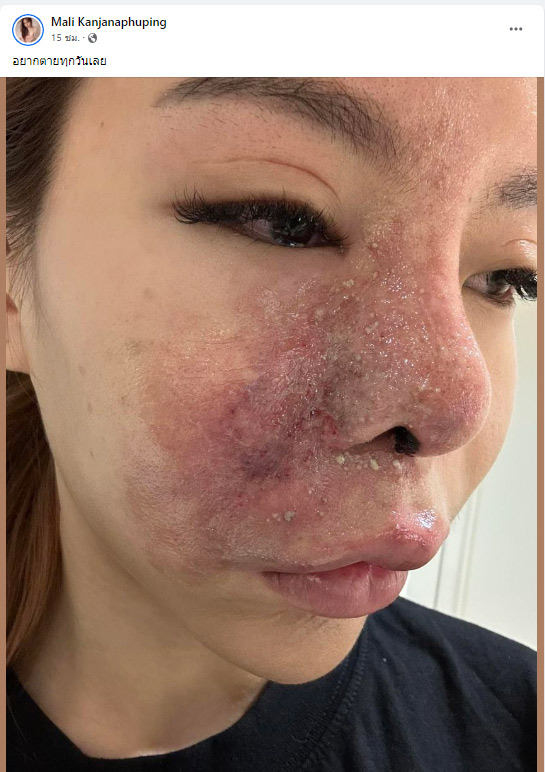 แพ้ฟิลเลอร์ แพ้ฟิลเลอร์