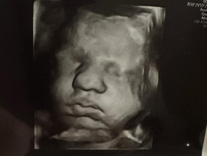 ท้องลูกแฝด ในมดลูกแฝด ท้องลูกแฝด ในมดลูกแฝด