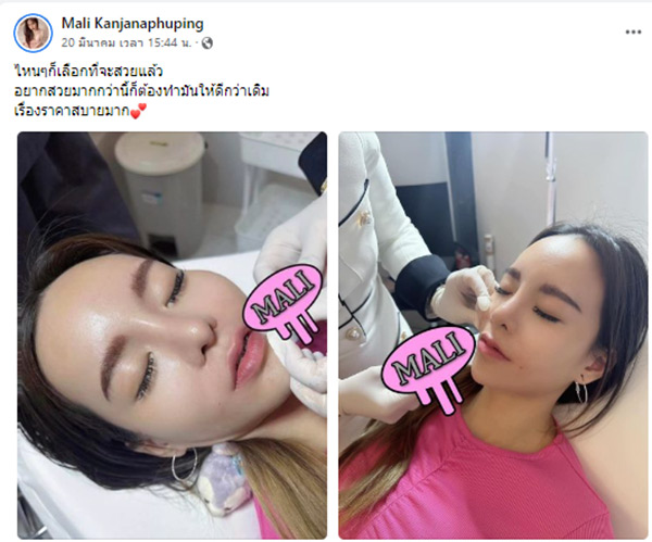 แพ้ฟิลเลอร์ แพ้ฟิลเลอร์