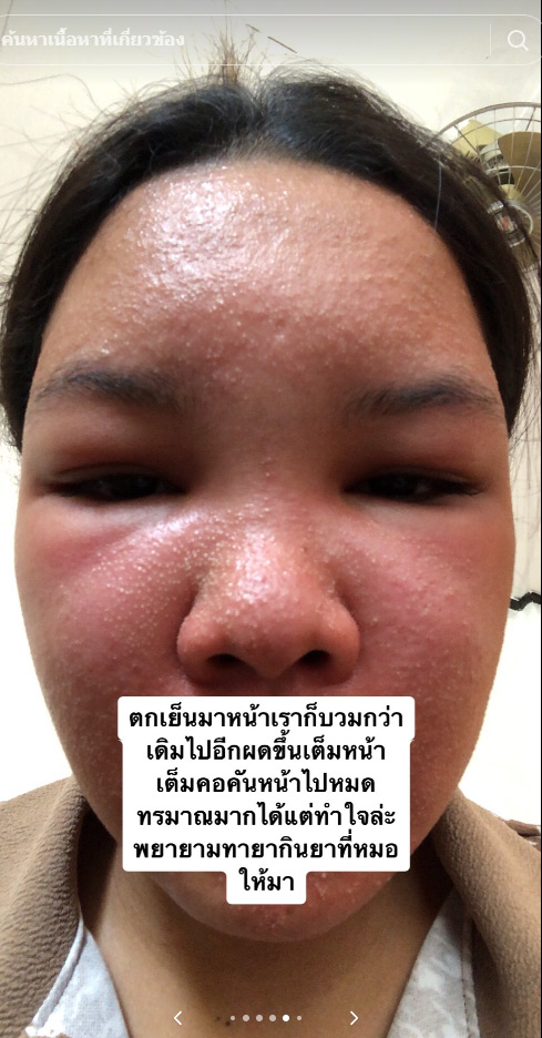 สาวรีวิว ครีมหน้าขาว หน้าอักเสบ ผื่น บวม แดง สาวรีวิว ครีมหน้าขาว หน้าอักเสบ ผื่น บวม แดง